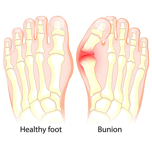 illustration of a foot with a bunion