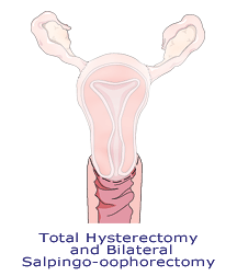 Image showing total hysterectomy and bilateral salpingo-oophorectomy