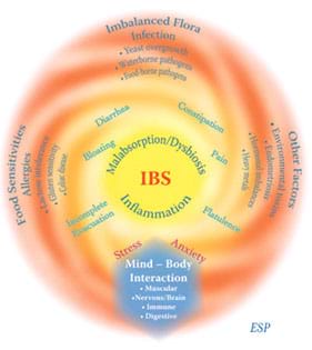 Illustration of the causes and symptoms of irritable bowel syndrome. Illustration of the causes and symptoms of irritable bowel syndrome