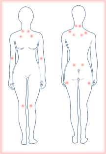 Fibromyalgia tender points