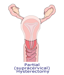 Image showing partial(supracervical) hysterectomy