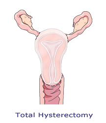 Image of total hysterectomy