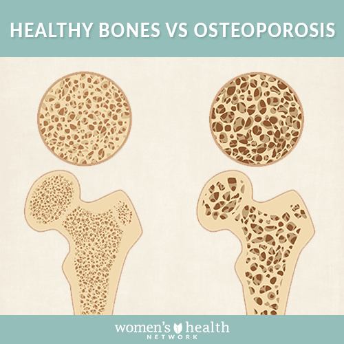 Healthy bones vs osteoporosis bones. 