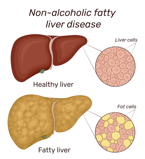 What is non-alcoholic fatty liver disease? 