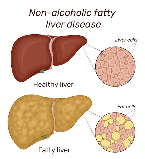 What is non-alcoholic fatty liver disease?