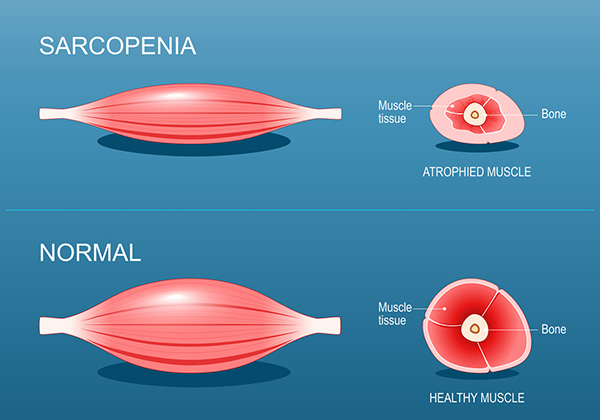 sarcopenia