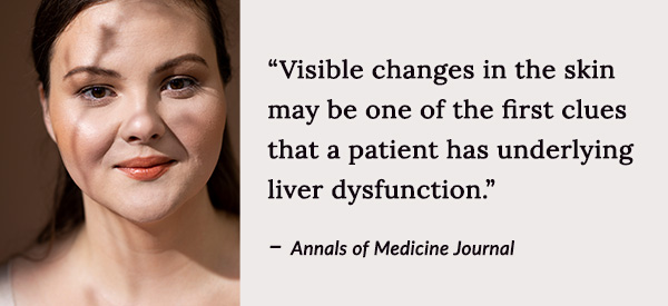 Visible changes in the skin may be one of the first clues that a patient has underlying liver dysfunction